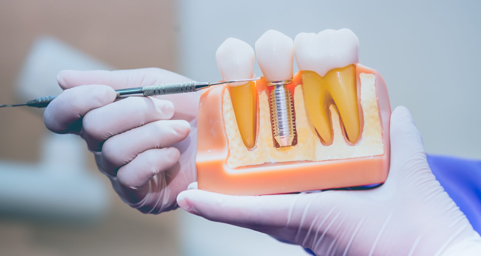 10 Best Dental Implant Marketing Strategies for Dentists [Video]
